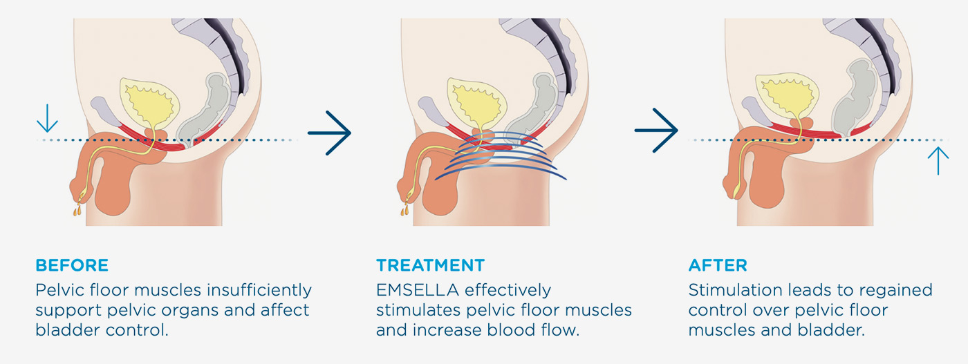 Emsella for Men: Non-Invasive Treatment for ED and Incontinence